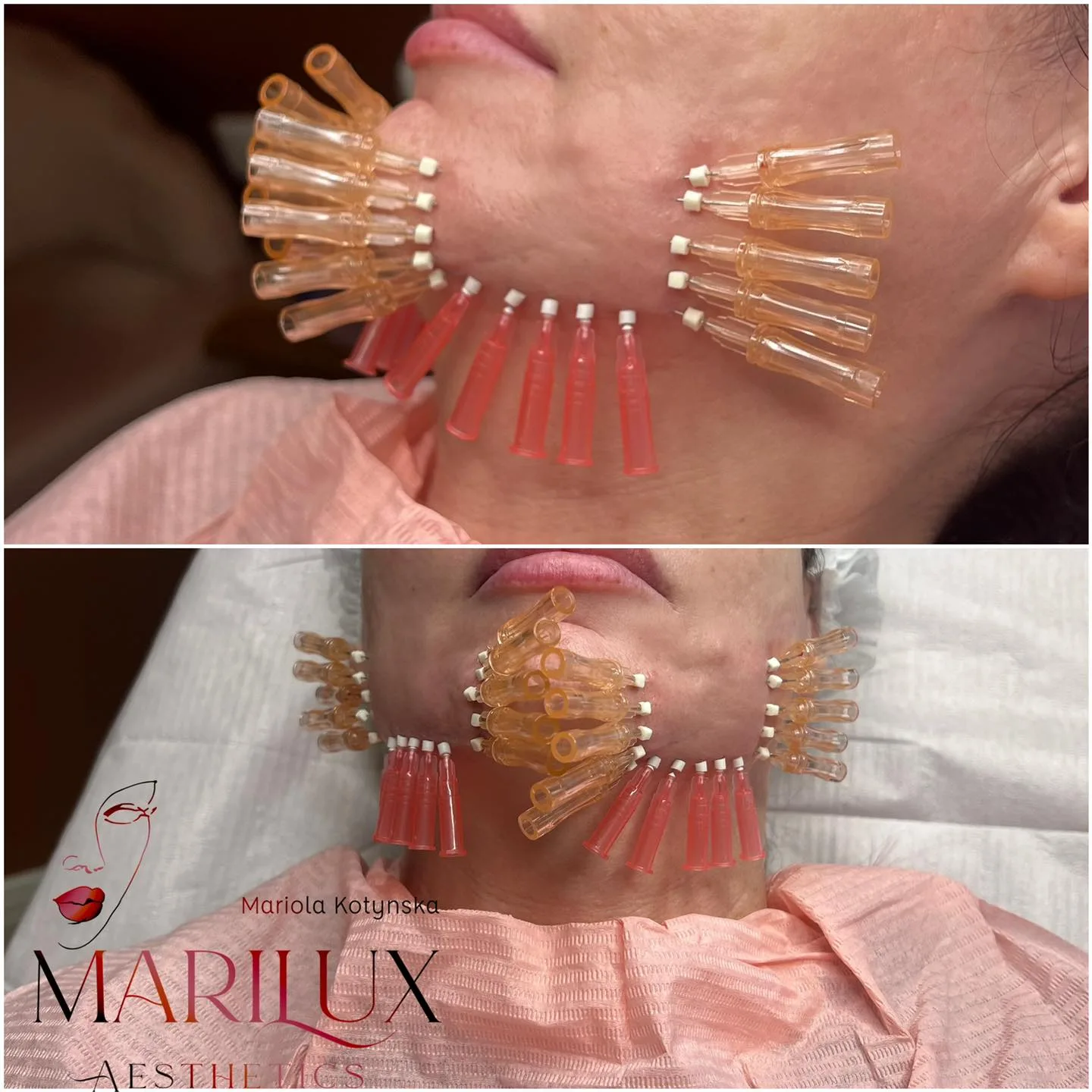 PDOS polydioxanone thread lifting treatment on face