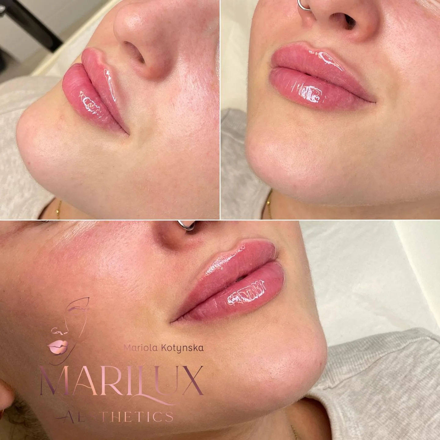 Lip filler results — Marilux Aesthetics