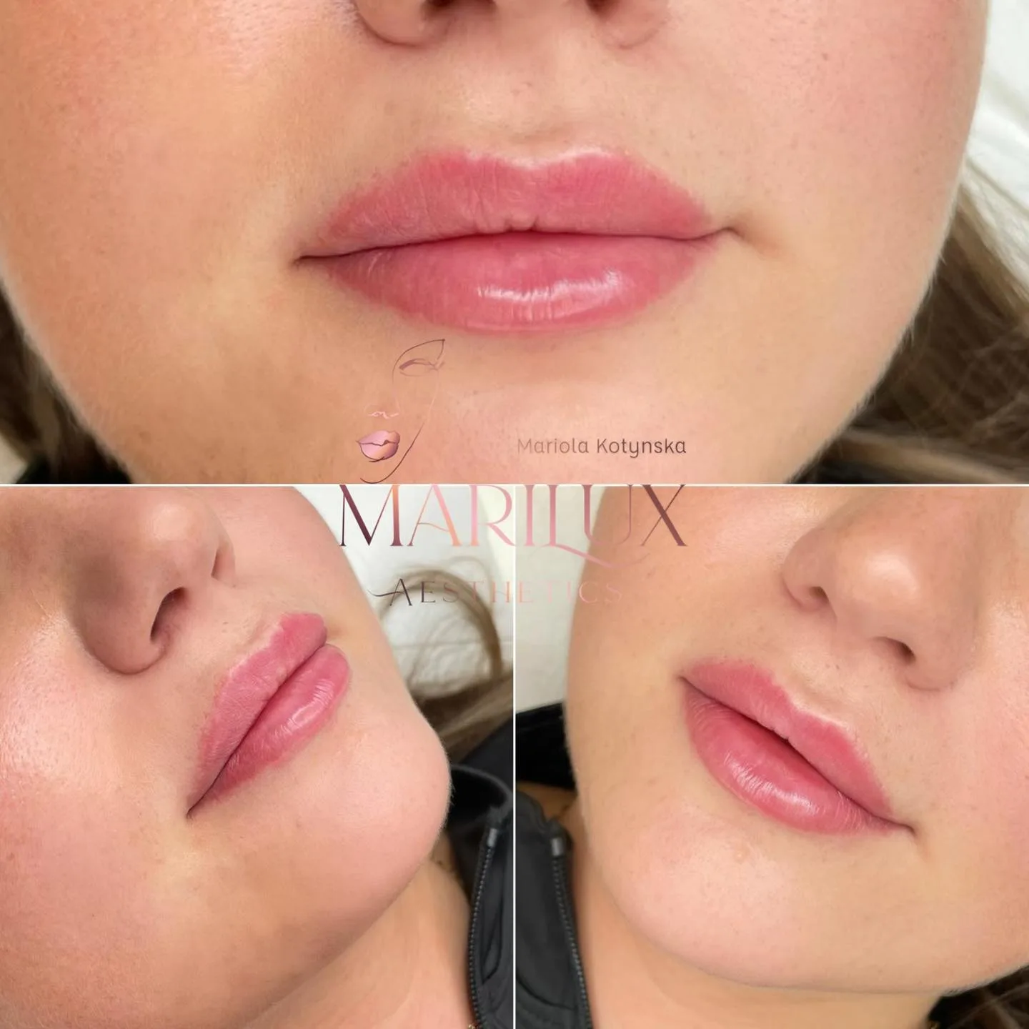 Natural lip enhancement results