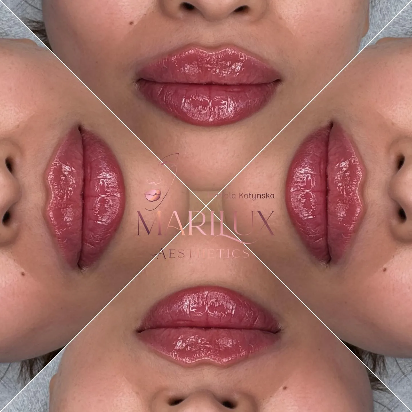 Premium lip filler treatments quad collage