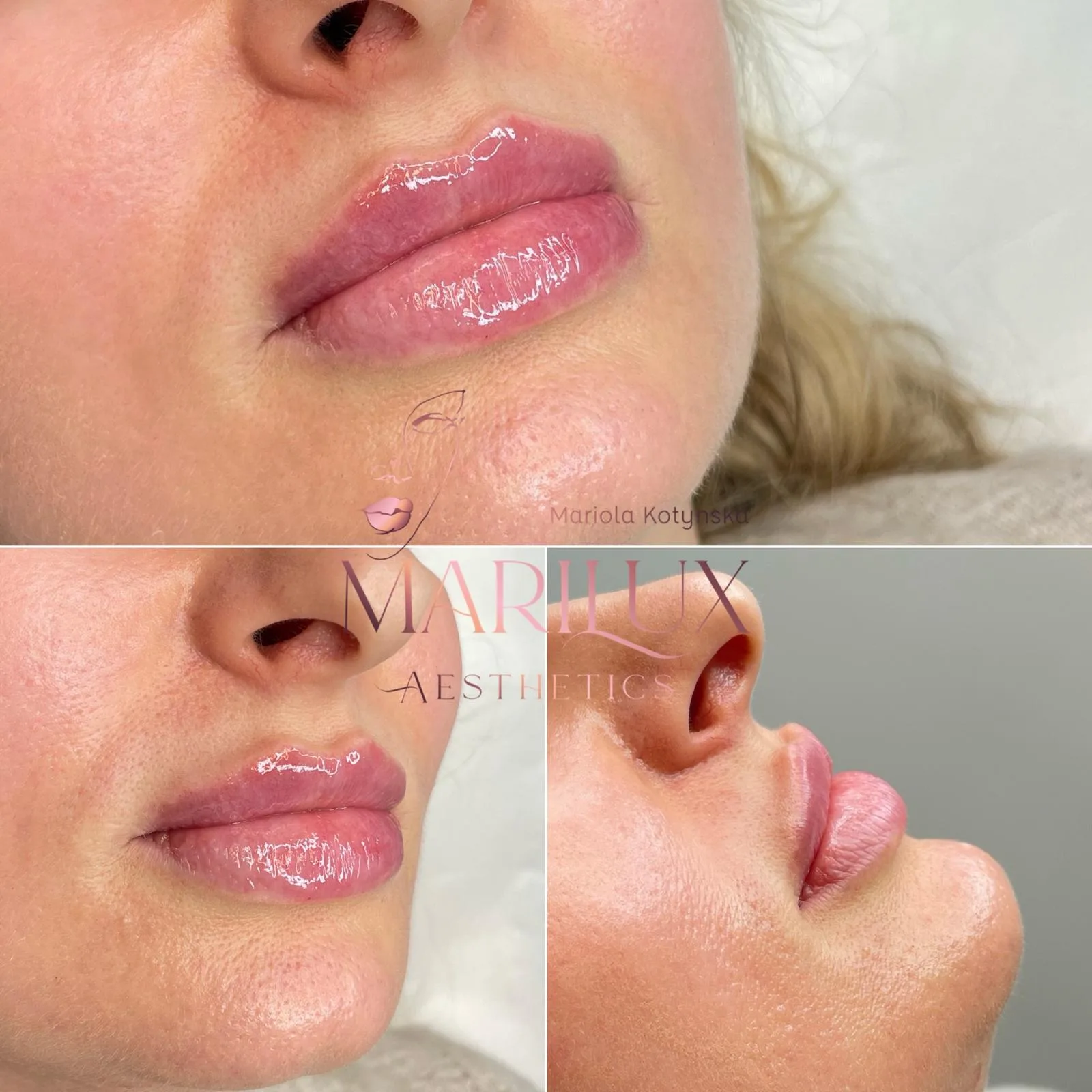Lip filler before and after — natural results at Marilux Aesthetics, Sligo