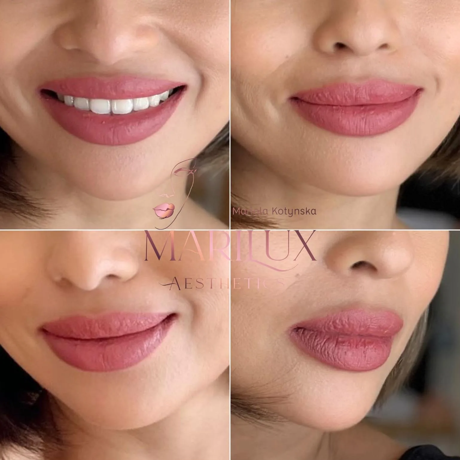 Mature lips enhanced with lip filler — before and after, Sligo