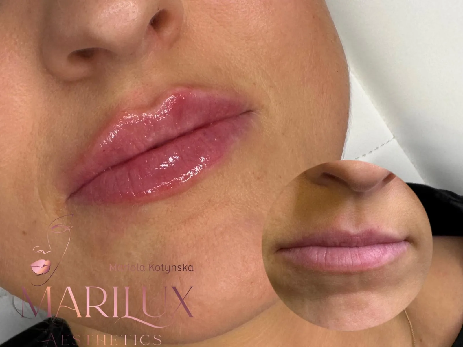 Plump natural lips after filler — before and after comparison, Sligo