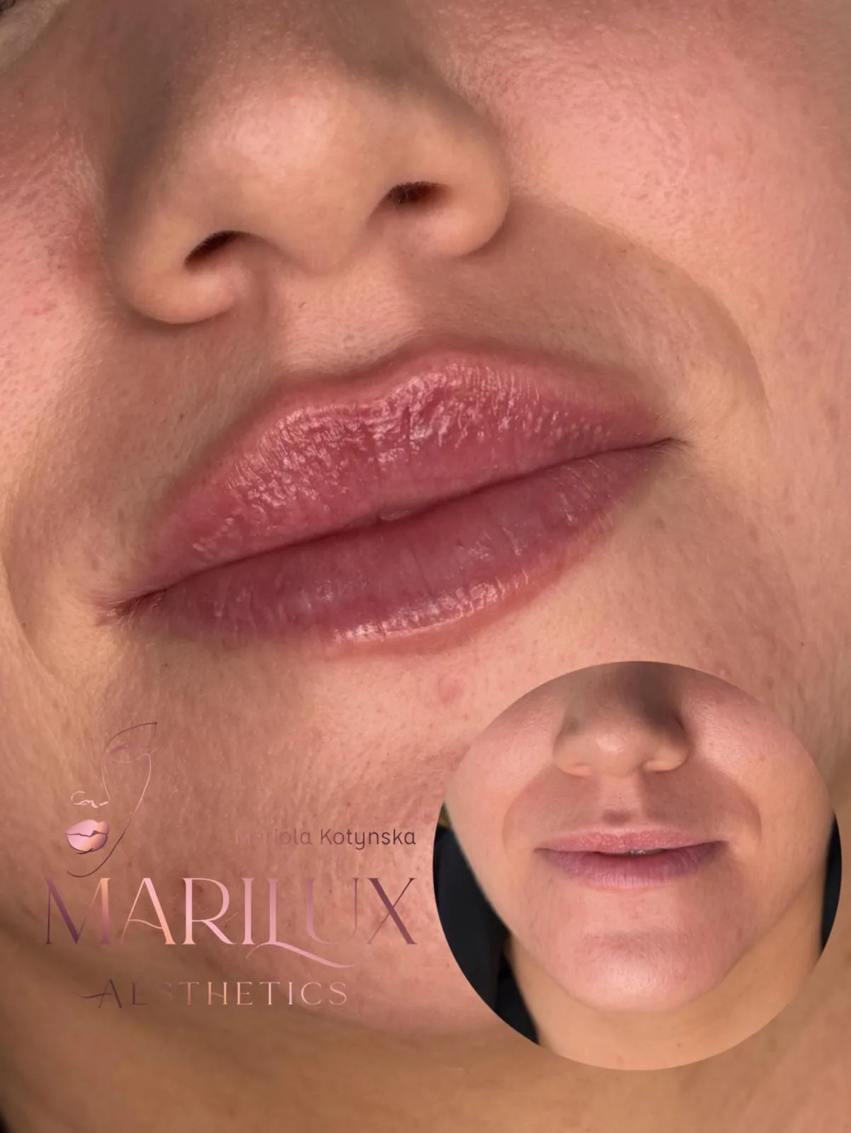 Lip volume transformation before and after — Ballysadare clinic