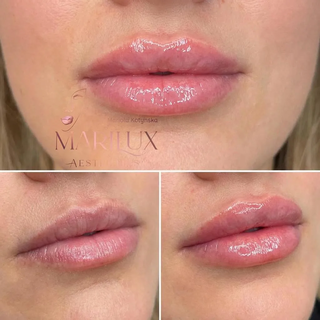 Natural lip filler results by aesthetic nurse Mariola Kotynska, Sligo