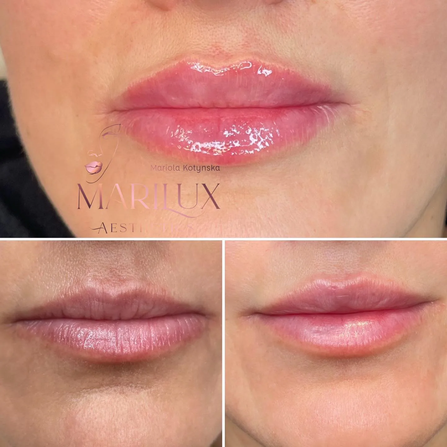 Lip filler result 1 — Marilux Aesthetics